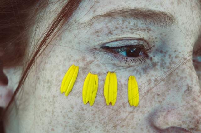 Laser to Remove Moles and Freckles