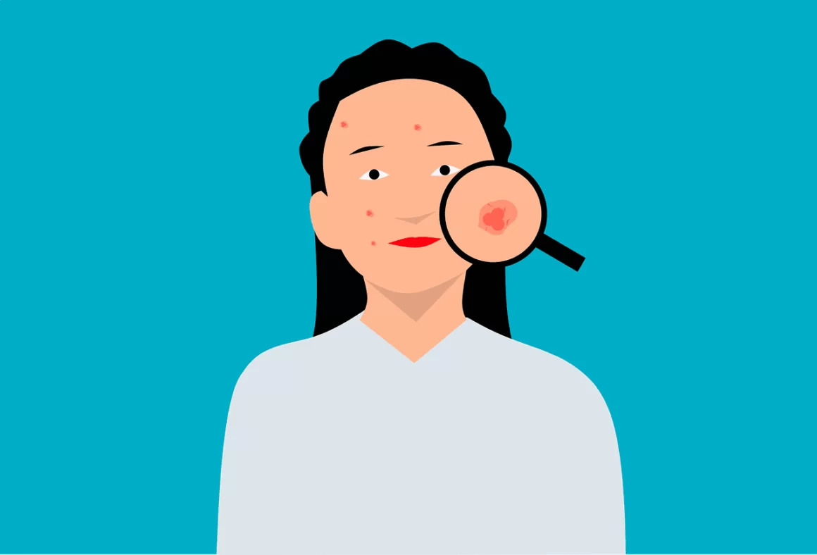 Fungal infection on the skin and arm with treatment Image