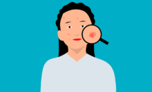 Fungal infection on the skin and arm with treatment Image