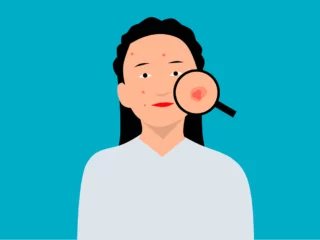 Fungal infection on the skin and arm with treatment Image