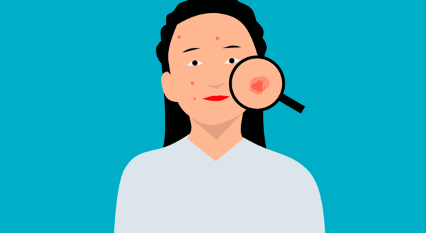 Fungal infection on the skin and arm with treatment